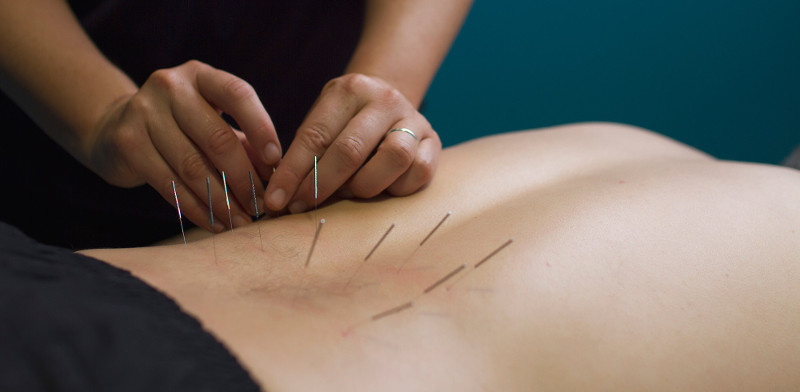 Best Outlet for Safe and Hygienic Acupuncture Needles