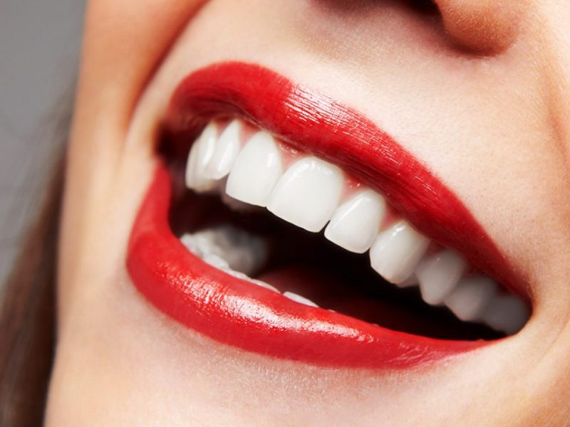 Dental Veneers Is Solution to a Perfect Smile.