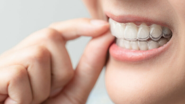 The Scientific Truth About Clear Aligners in Orthodontics
