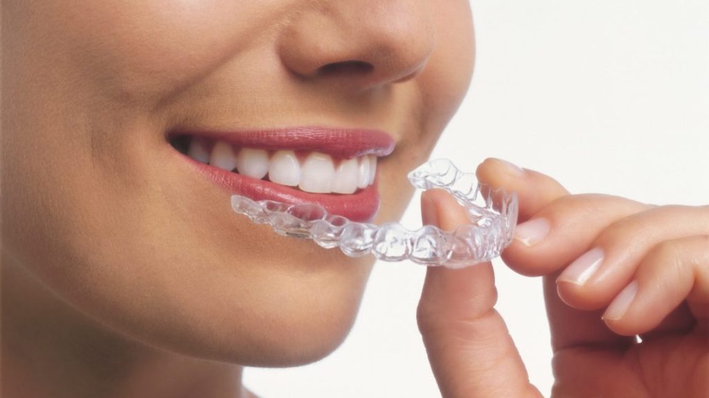 clear aligners