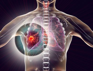 What is a lung tumor and how it is treated?